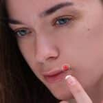 Aciclovir: Usos y dosis recomendadas para tratamiento antiviral