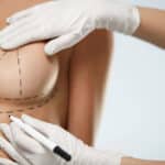 Beneficios y riesgos de la mastopexia: eleva tus mamas con seguridad