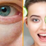 Bolsas en los Ojos: Descubre qué son y cómo tratarlas