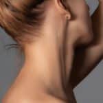 Eliminación de cicatrices en el cuello: el tratamiento más efectivo