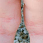 Cómo tratar la dermatitis por alergia al suavizante