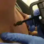 Nitrógeno líquido: el frío que combate las verrugas de forma efectiva