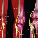 Electromiografía y neurografía: claves tras sospecha neuropática