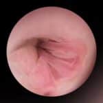 Embarazo y miomas uterinos: ¿Cómo afectan al embarazo?