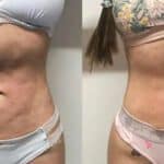 Fibrosis postquirúrgica: Conoce cómo afecta a los pacientes