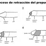 Fimosis Tipo 2: Síntomas, causas y tratamiento completo