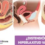 Hiperlaxitud vaginal y placer