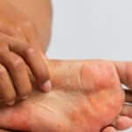 Hongos en los pies: todo sobre el pie de atleta, síntomas y prevención