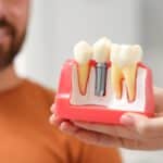 ¿Los implantes dentales duelen al colocar la corona? Descúbrelo aquí