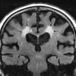 La leucoaraiosis: cómo evoluciona y afecta la función cerebral