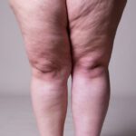 Lipedema: síntomas y tratamiento