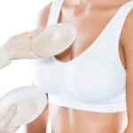Mamoplastia: todo sobre este procedimiento estético