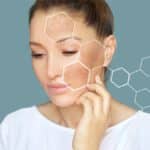 Manchas hormonales en la cara: ¿Cómo eliminarlas eficazmente?