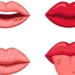 Tratamiento natural para la mucositis por quimioterapia