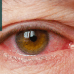 Ojo seco, coronavirus y su relación con la blefaritis