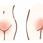 Picor intenso: señales claras de candidiasis genital