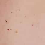 Puntos rojos similares a lunares: causas y eliminación