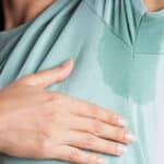 Resultados del bótox en axilas y manos para hiperhidrosis