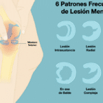 Rodilla sin menisco: ¿Por qué a veces estalla y cómo evitarlo?