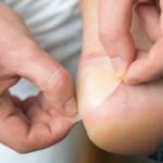 Consejos para prevenir y curar rozaduras en los pies