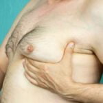 Pecho del hombre: diferencias entre ginecomastia y grasa