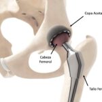 Simulador post artroplastia de cadera