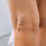 Tipos de varices en las piernas: clasificación y características