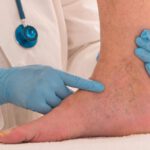 Trombosis venosa: Tratamientos y síntomas para aliviar la flebitis