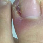 Uñas encarnadas: tipos y tratamiento con un podólogo