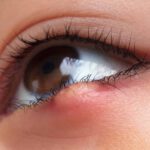 Uso de agua de mar para orzuelo: beneficios y precauciones