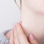 Verrugas con pelos: conoce sus tipos y cómo tratarlas